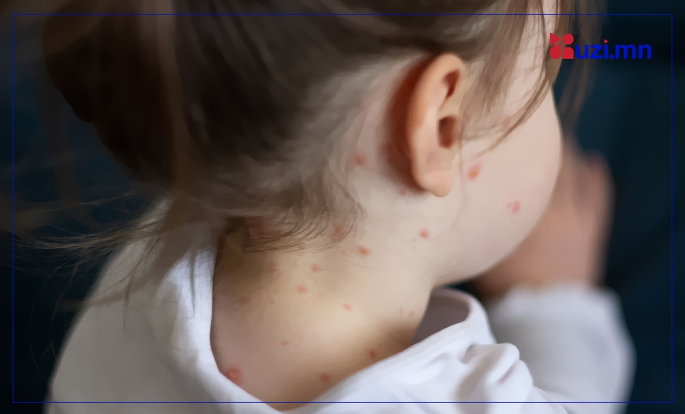 ХӨСҮТ: Улаанбурхан өвчний батлагдсан тохиолдол 11 нэмэгджээ